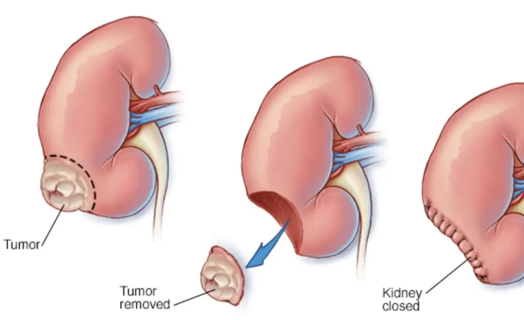 Robotic Partial Nephrectomy - Fairbanks Urology