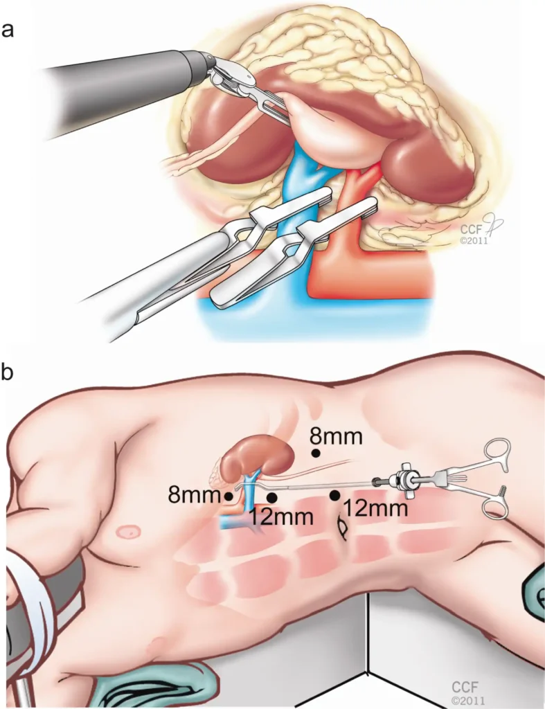 Robot-assisted Laparoscopic Partial Nephrectomy: Step-by-step Contemporary Technique and Surgical Outcomes at a Single High-volume Institution - European Urology